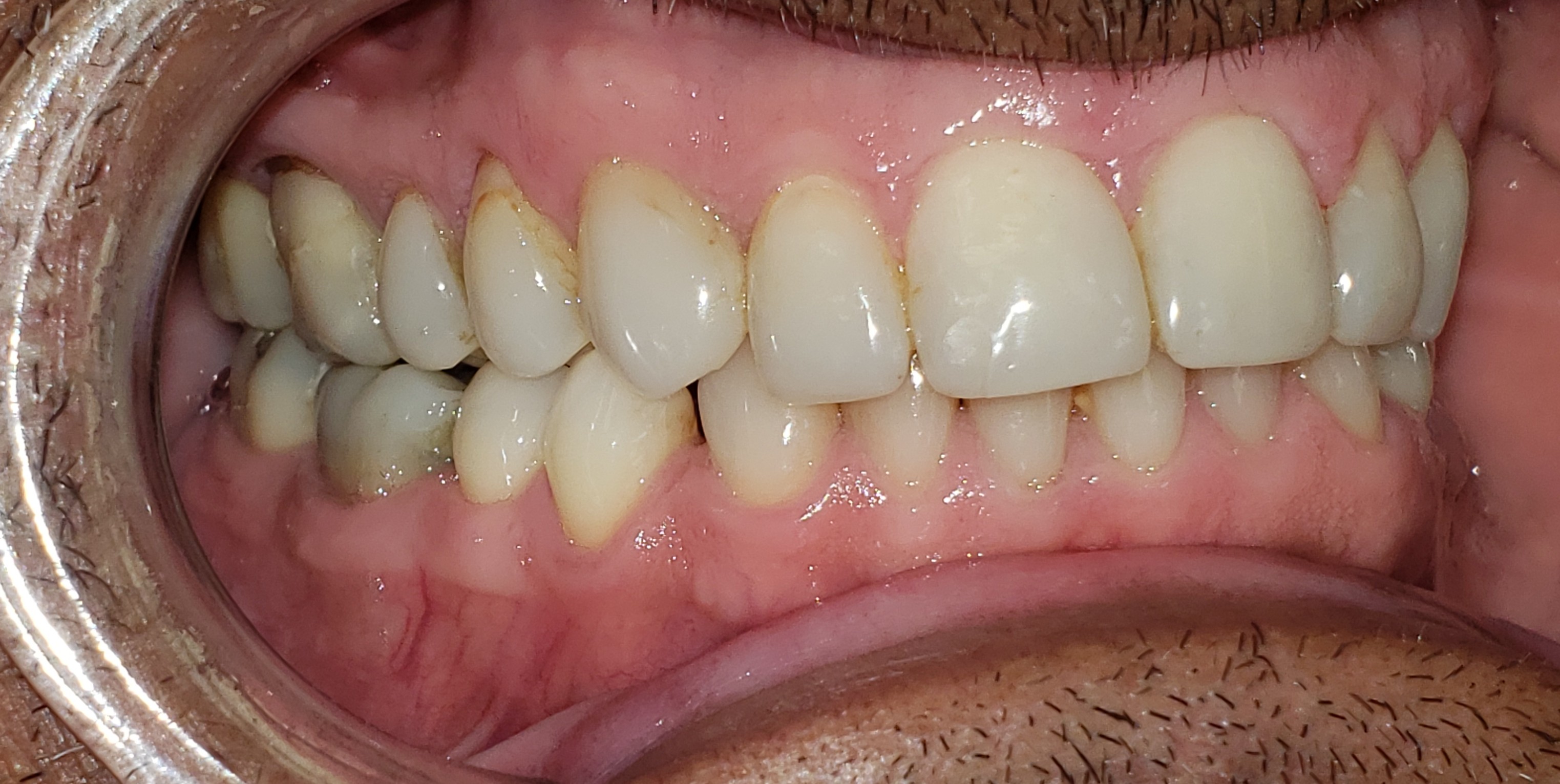 Right side reference