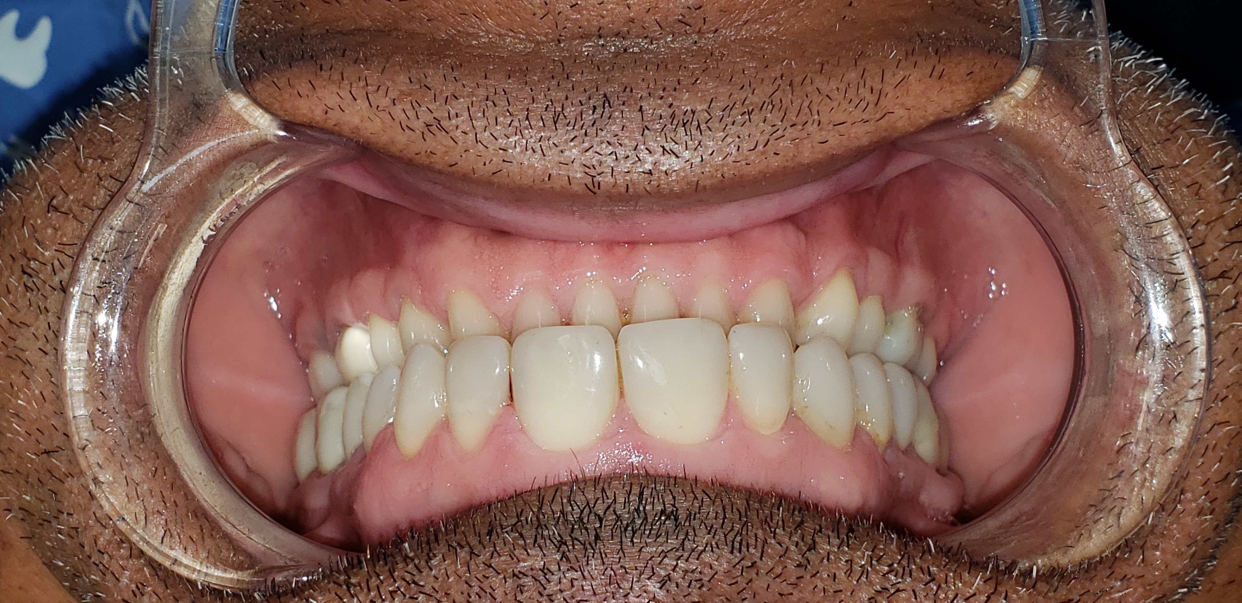 Front view reference