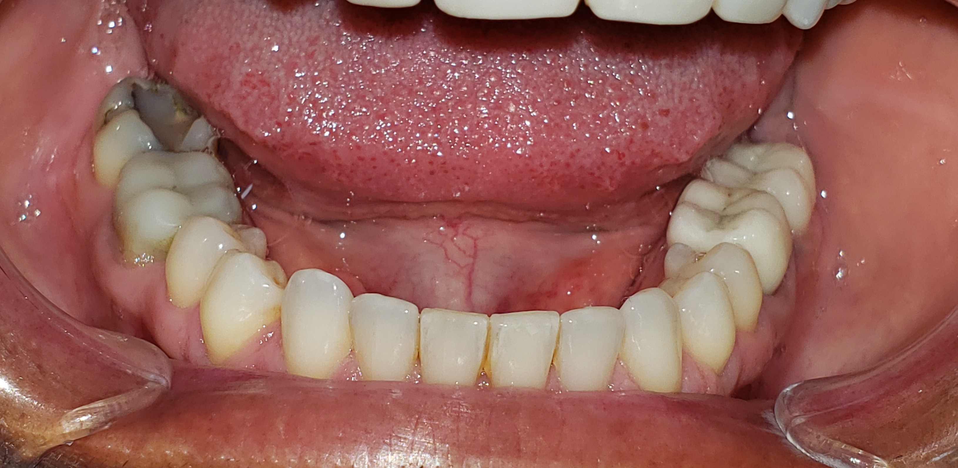 Lower arch reference