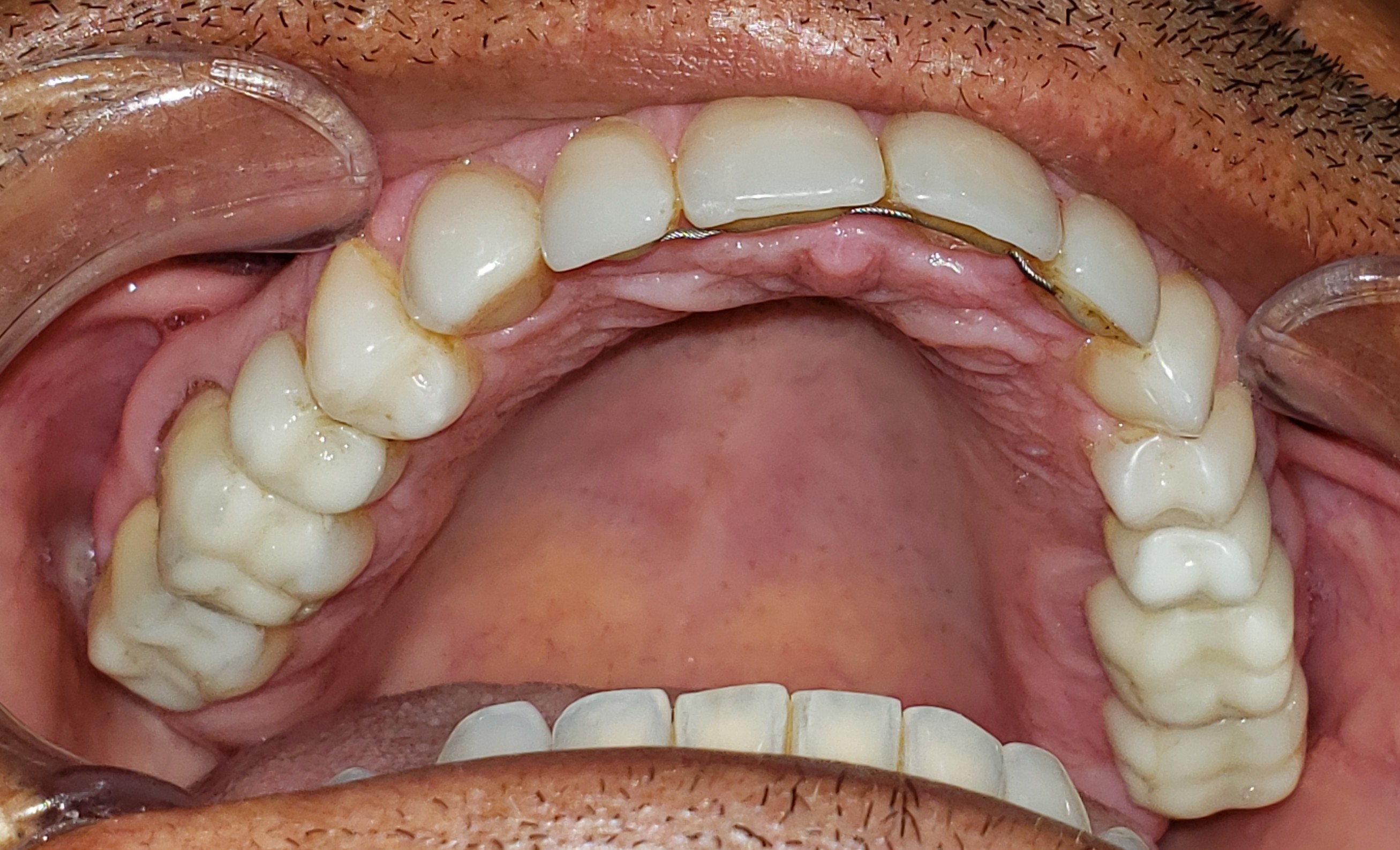 Upper arch reference